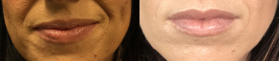 Botox before and after photo