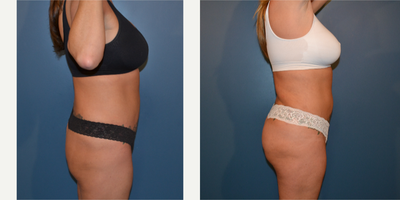 Brazilian Butt Lift before and after photo