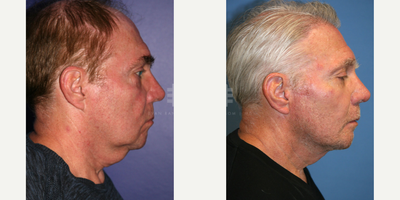 Chin Implant before and after photo