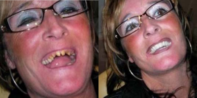 Dental Crown before and after photo