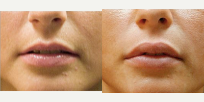 Dermal Fillers before and after photo