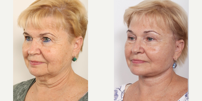Eyelid Surgery before and after photo