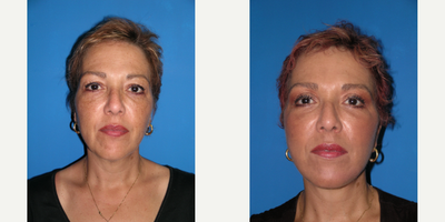 Facelift before and after photo