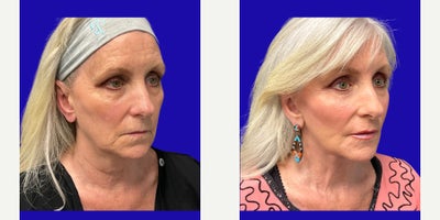 Facelift before and after photo