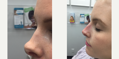 Juvederm before and after photo