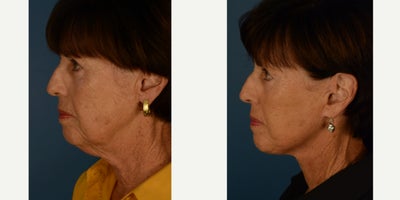 Neck Lift before and after photo