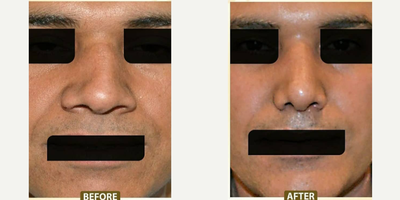 Rhinoplasty before and after photo