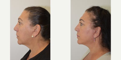 Deep Plane Facelift before and after photo