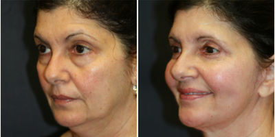 Eyelid Surgery before and after photo