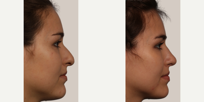 Rhinoplasty before and after photo