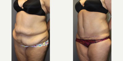 Tummy Tuck before and after photo