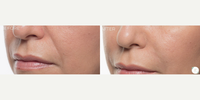 Bellafill before and after photo