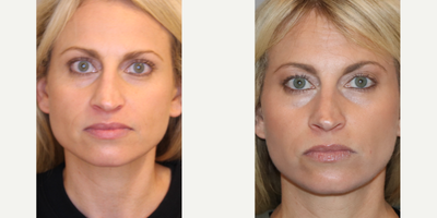 Botox before and after photo