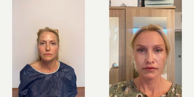 Brow Lift before and after photo