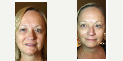 Contour Thread Lift before and after photo