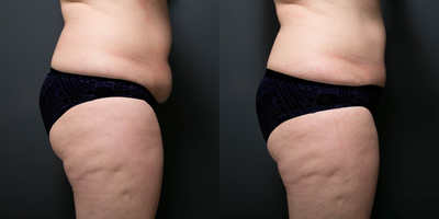 CoolSculpting before and after photo