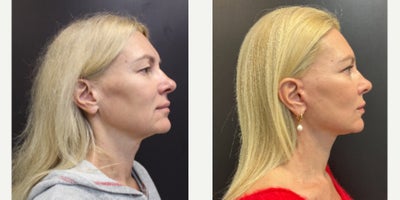 Mini Facelift before and after photo