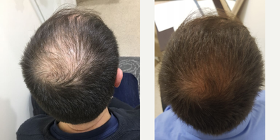 Hair Loss Treatment before and after photo
