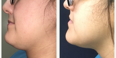 Kybella before and after photo