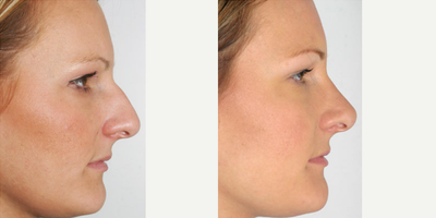 Rhinoplasty before and after photo