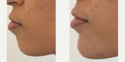 Chin Filler before and after photo
