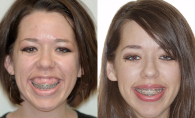 Damon Braces before and after photo