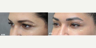 Eyelid Surgery before and after photo