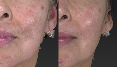 Laser Resurfacing before and after photo