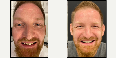Porcelain Veneers before and after photo