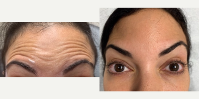 Botox before and after photo