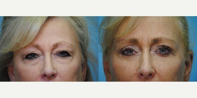 Brow Lift before and after photo