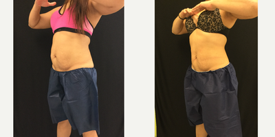CoolSculpting before and after photo