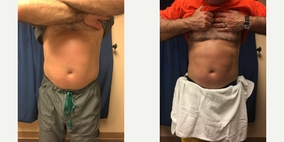 Exilis before and after photo