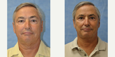 Neck Lift before and after photo