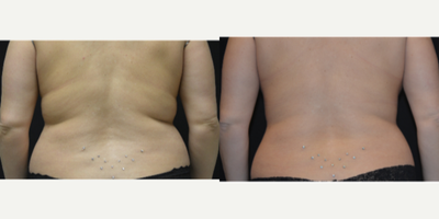 CoolSculpting before and after photo