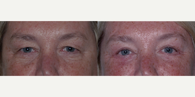 Eyelid Surgery before and after photo