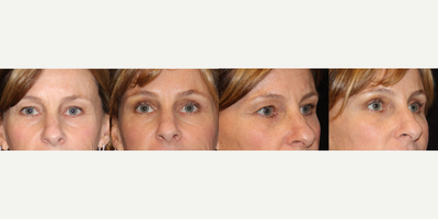 Eyelid Surgery before and after photo