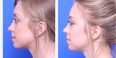 Cheek Lift before and after photo
