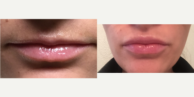 Juvederm before and after photo