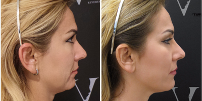 Kybella before and after photo