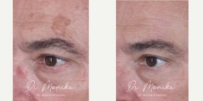Laser Resurfacing before and after photo