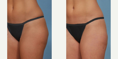 Liposuction before and after photo