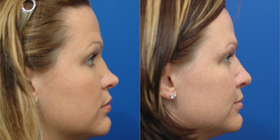 Rhinoplasty before and after photo