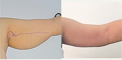 Arm Lift before and after photo