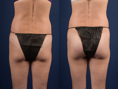 Butt Implants before and after photo