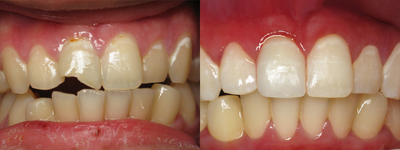 Dental Crown before and after photo