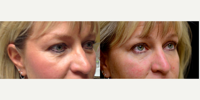 Dermal Fillers before and after photo
