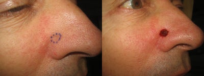 Mohs Surgery before and after photo