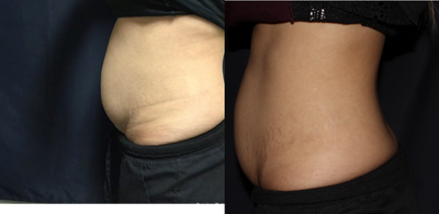 SculpSure before and after photo
