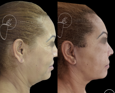 Facelift before and after photo